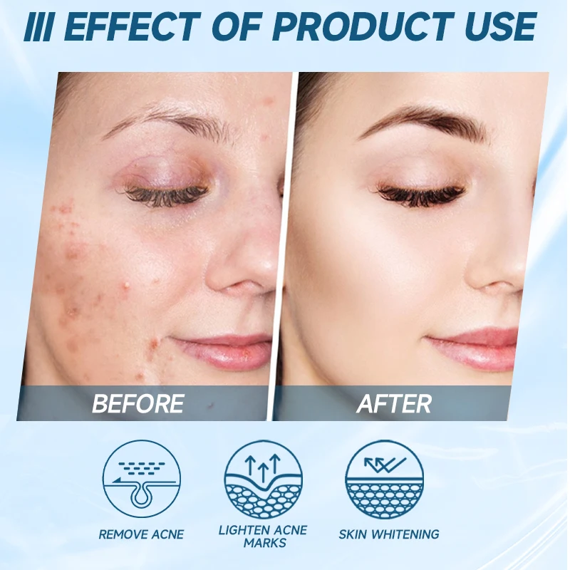 Oligopeptide Anti Acne Face Serum EGF Acne Treatment Essence Diminish Pigmentation Moisturizing Skincare Repair Skin Barrier 4
