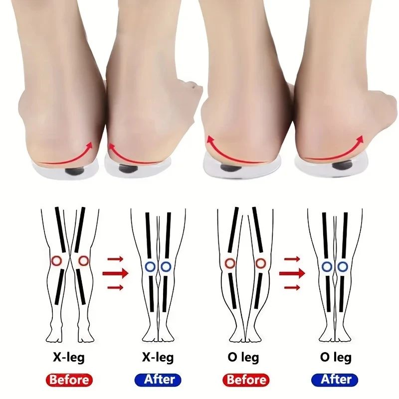 

1Pair O/X Leg Type Valgus Correction Men Women Silicone Gel Shoes Insole Orthopedic Insoles for Feet Magnet Massage Shoe Pads
