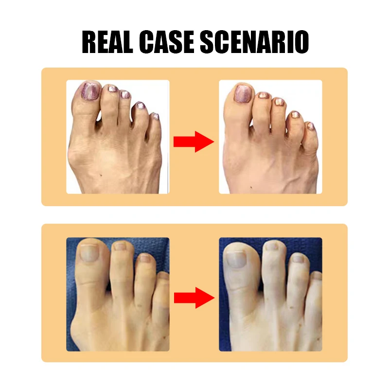 2Pcs=1Pair Protect Toe Separator Bunion Hallux Valgus Corrector Thumb Correction Material Soft Straightener Foot Care Tool H066