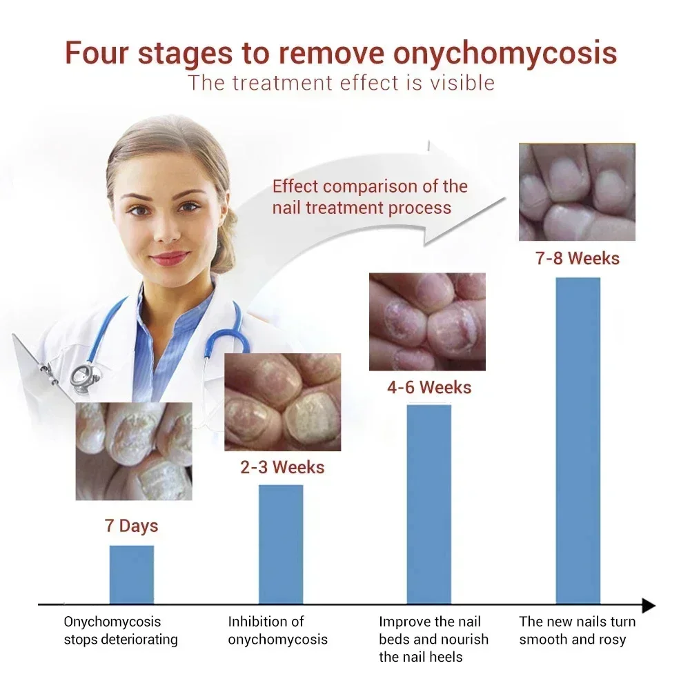 Nail Fungus Treatment Toenail Nail Repair Fingernail Device Essential Oil Onychomycosis Care
