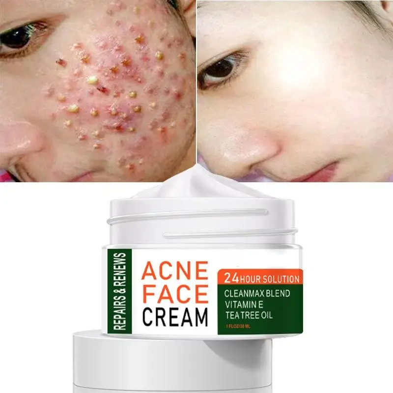 

2022 Best Organic Whitening Herbal Tea Tree Oil Acne Spot Treatment Removing Anti Acne Face Cream