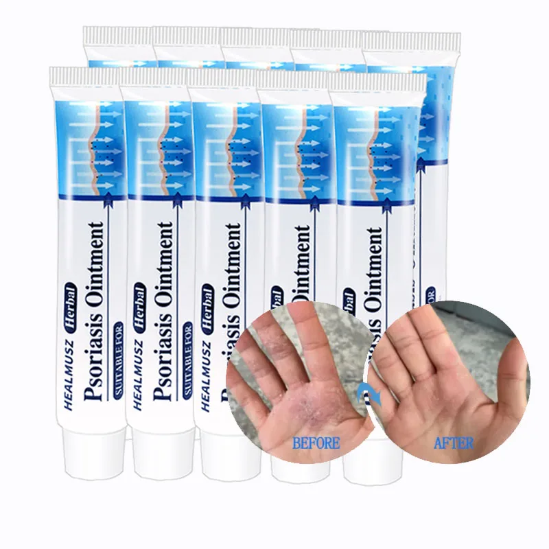 

5/10PCS Psoriasis Cream Eczema Ointment Hand Tinea Psoriasis Treatment Foot Odor Versicolor Inhibit Dermatitis Anti-itch Cream