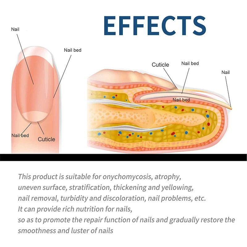 32/64PCS Foot Nail Repair Patch Grey Fungal Nail Thicken Soft Paronychia Infection Feet Nail Correction Sticker Ingrown Toenail