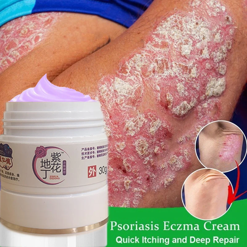 

30g ZB Herbal Antibacterial Cream Psoriasis Cream Itching Relief Eczema Rash Urticaria Scaling Treatment Medical Plaster