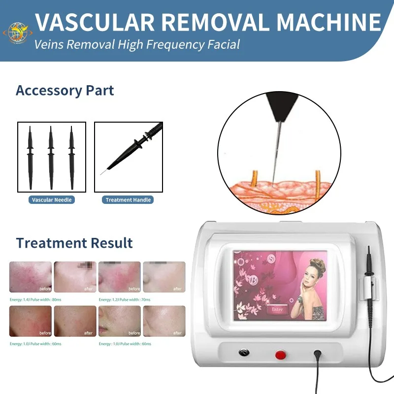 

Beauty Equipment 30Mhz R-F High Frequency For Vascular Vein Removal Machine Vascular Removal And Nail Fungus Removal