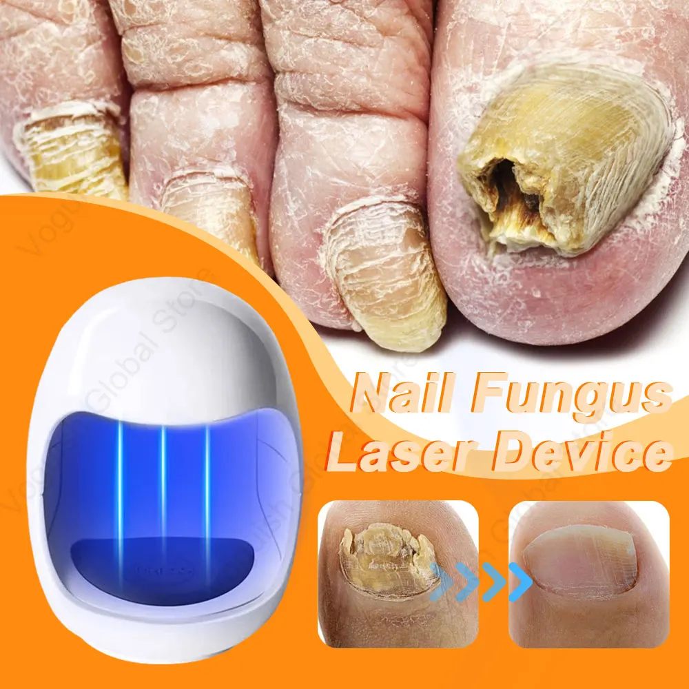 Nail Fungus Remover Laser Nail Fungus Treatment Device Repair Ingrown Toenail Fingernail Fungus Corrector Podiatry Mold Laser Nails with Mushrooms