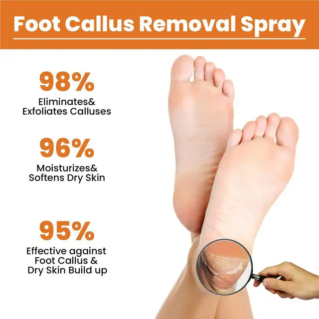 Foot Callus Removal Spray 1.01 Oz Dry Feet Skin Remover Foot Care Callus  Softener For Exfoliation Hydrating Quickly Nourish Feet - AliExpress