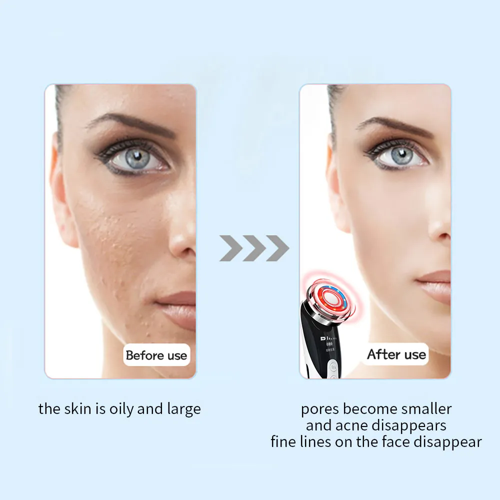 Face Massager Skin Rejuvenation Radio Mesotherapy LED Facial Lifting Beauty Vibration Wrinkle Removal Anti Aging Radio Frequency 3 Face Massager Skin Rejuvenation Radio Mesotherapy LED Facial Lifting Beauty Vibration Wrinkle Removal Anti Aging Radio Frequency 3
