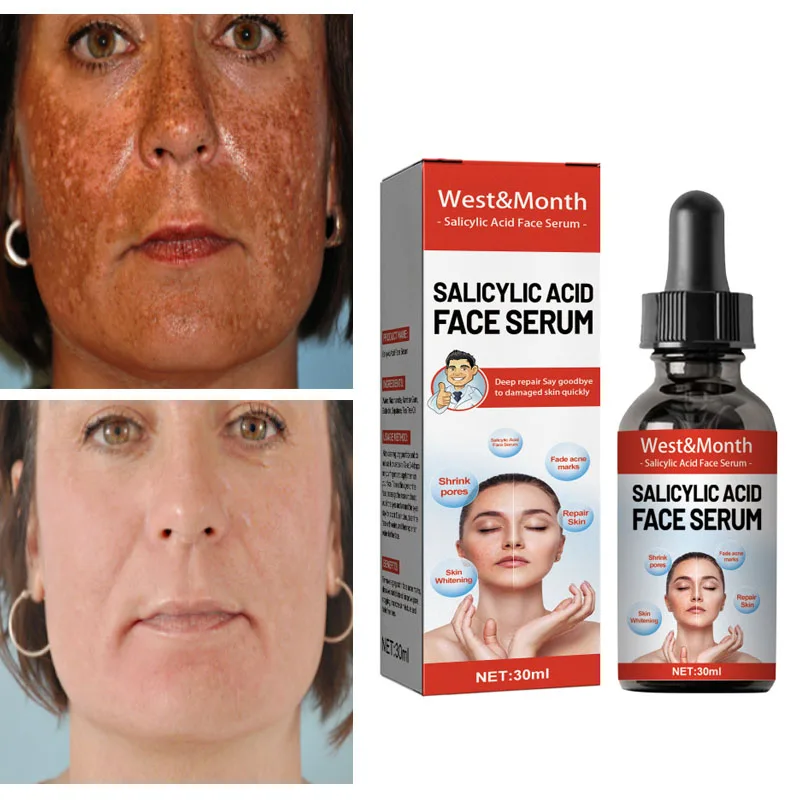 

Мерная Сыворотка для выцветания, мелазма, темные пятна, средство для удаления черных пятен, салициловая кислота, средство для увлажнения пор и ухода за кожей