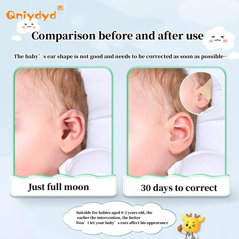 Roll Baby Ear Corrector Infant Protruding Ears Correction X