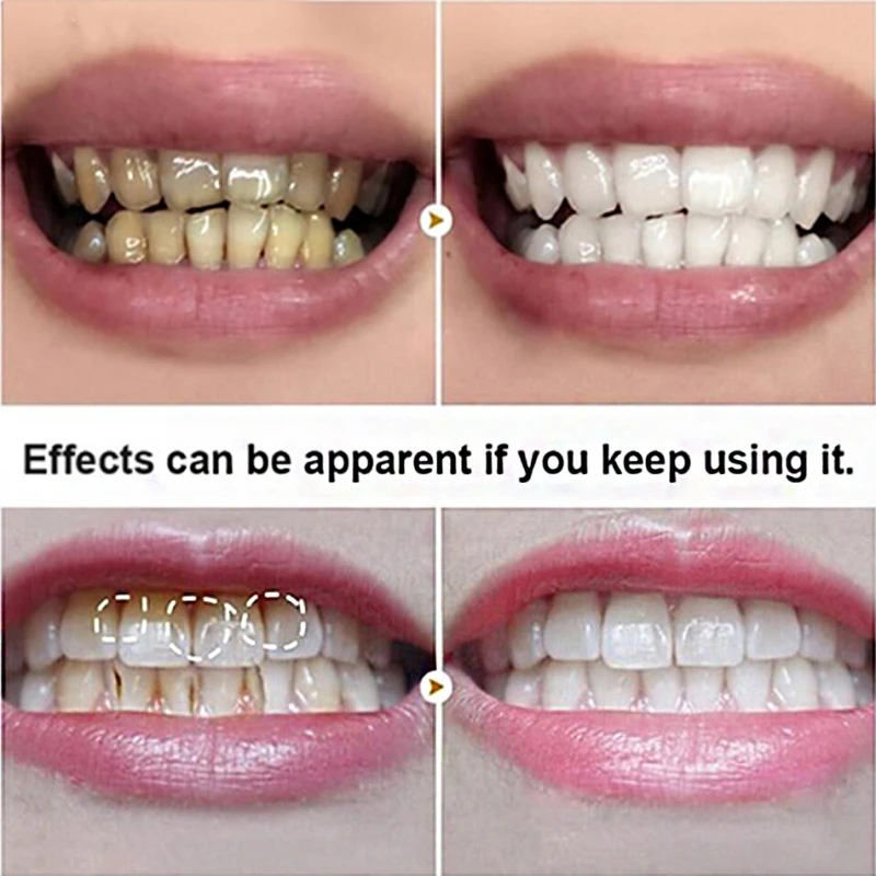 Baking Soda Teeth Braces