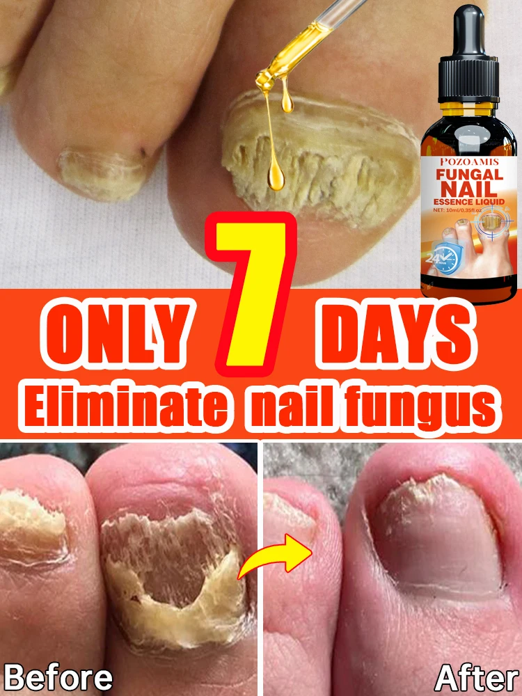 Fungus Nail Onychomycosis Treatment
