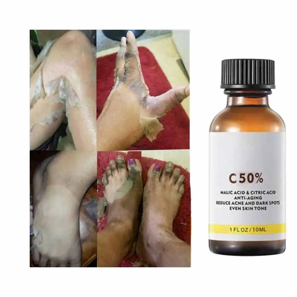 High Quality 50% Chemical Peel Tca Peel Acid Skin Superforce Pigmentation Lightening Melanin Acne Treatment Remove Scar