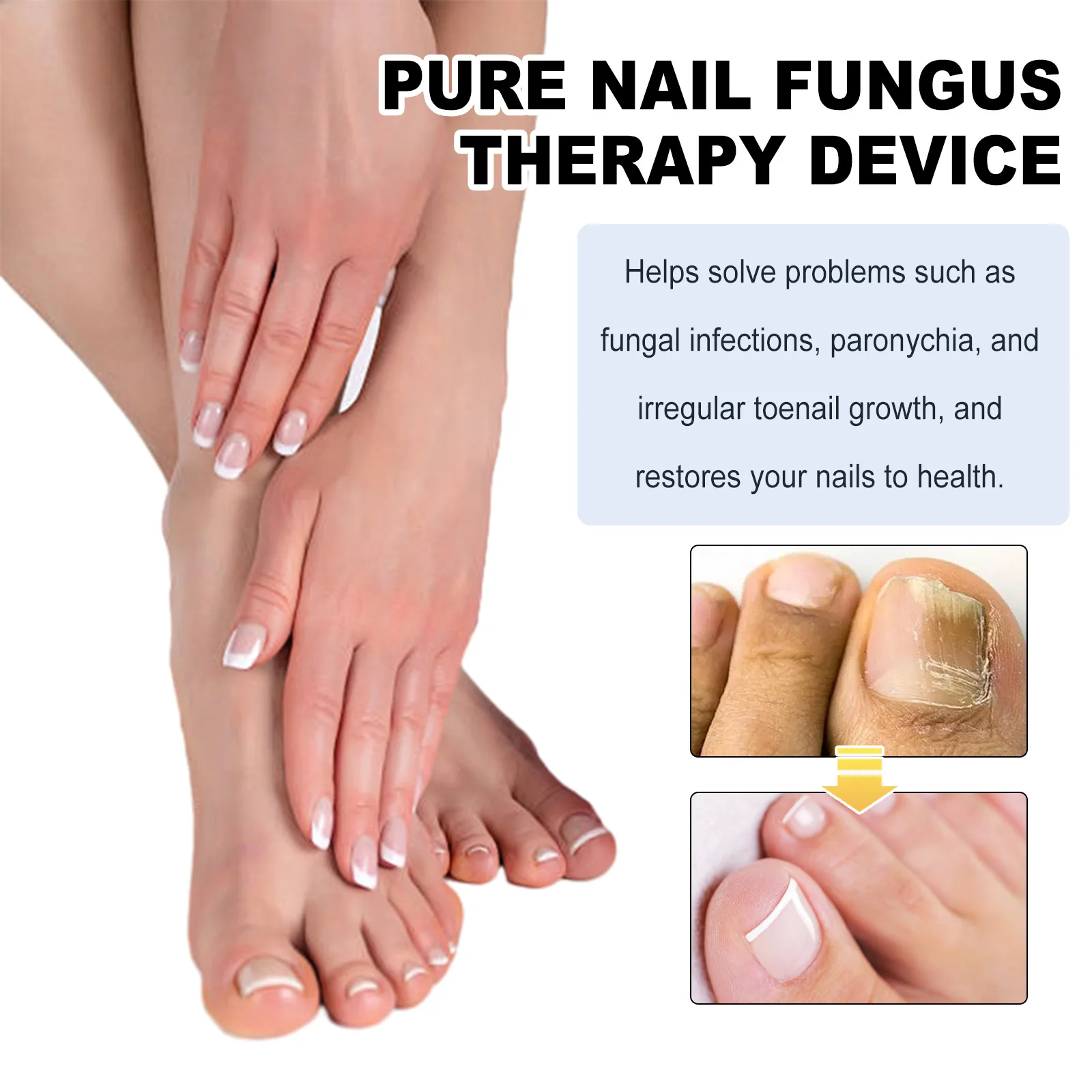 Fungal Nail Laser Treatment Device for Toenail