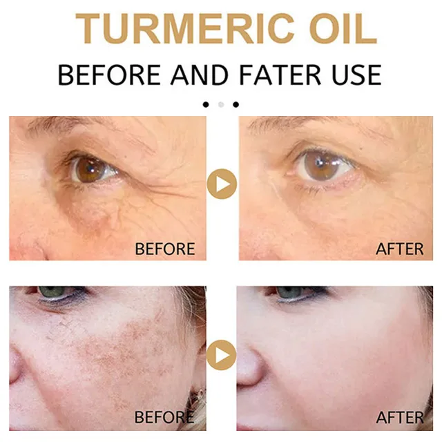 Kurkuma Fehérítő Szeplős Szérum Brighten Távolítsa El A Sötét Foltokat Melasma Megvilágít - Image 2