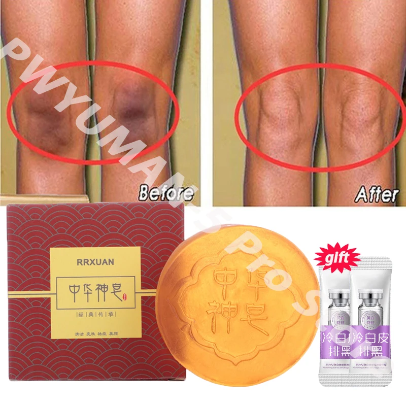 Body Whitening Soap Deep Clean Skin Chicken Skin Removal Soap Armpit Underarm Knees Bleaching Body Brighten White Care Products Body Whitening Soap