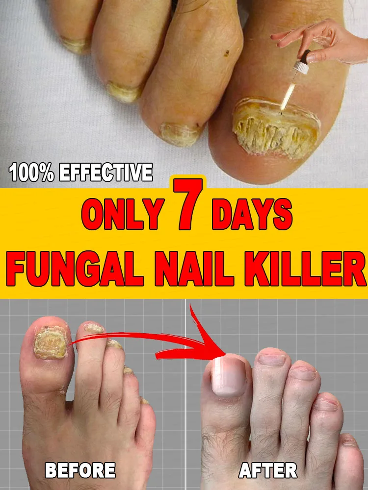 Black technology eliminate fungi and restore health fungus solution