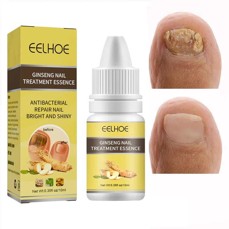 

Nail Fungal Treatment Feet Care Serum Anti Infection Paronychia Onychomycosis Nail Repair Gel Foot Toe Fungus Removal Essence