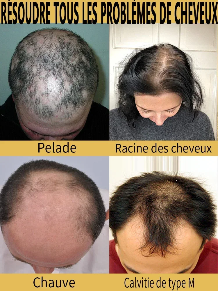Anti Hair Loss Spray 10ml for Hair Growth