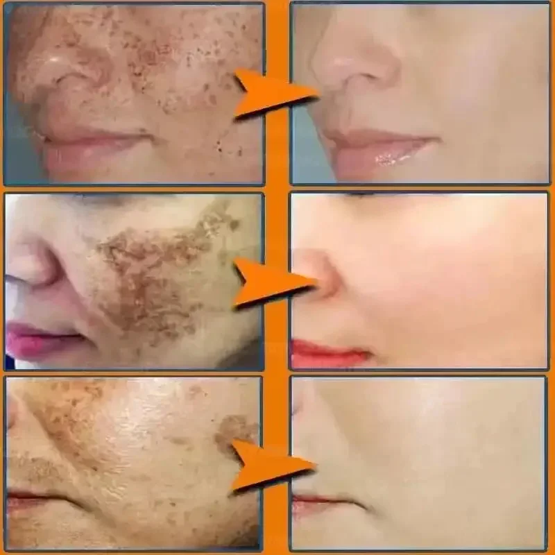 Description Picture 5 of itemWhitening Freckles Face Cream Removal Melasma Dark Spots Corrector Lighten Melanin Pigmentation Brighten Anti-Aging Beauty Care