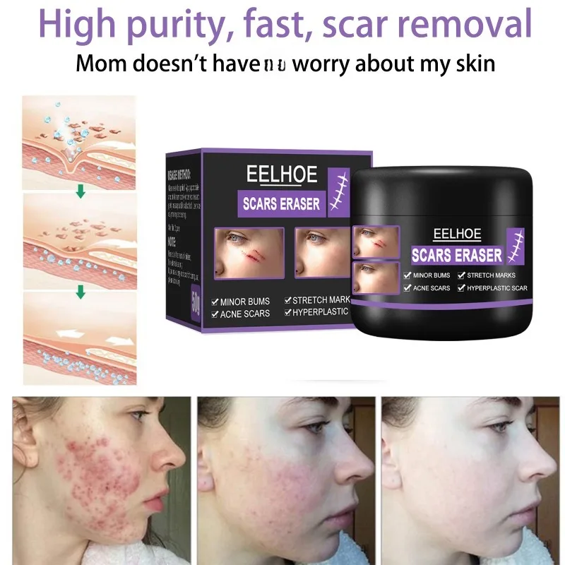Scar Removal Cream Repair Stretch Marks Burn Surgical fade Acne old Scars Treatment Gel Whitening Beauty skin Health Care
