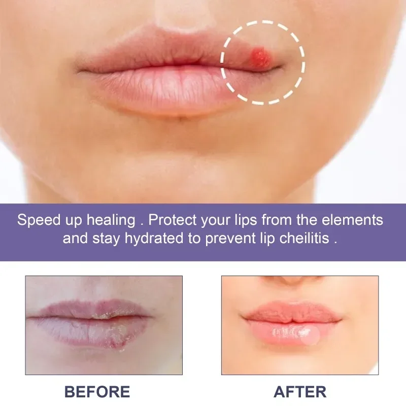 Cold Sores Patch Antibacterial Herpes Paste Repair Lip Skin Barrier Dry Cracked Moisturize Lips Care Treatment Cheilitis Sticker