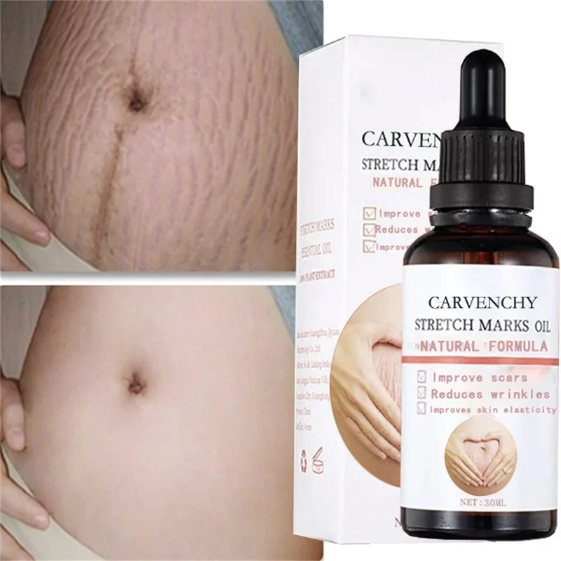 

Stretch Marks Remover Essential Oil Pregnancy Maternity Body New Old Stretch Mark Removal Serum Increase Elasticity Of Skin 30ml