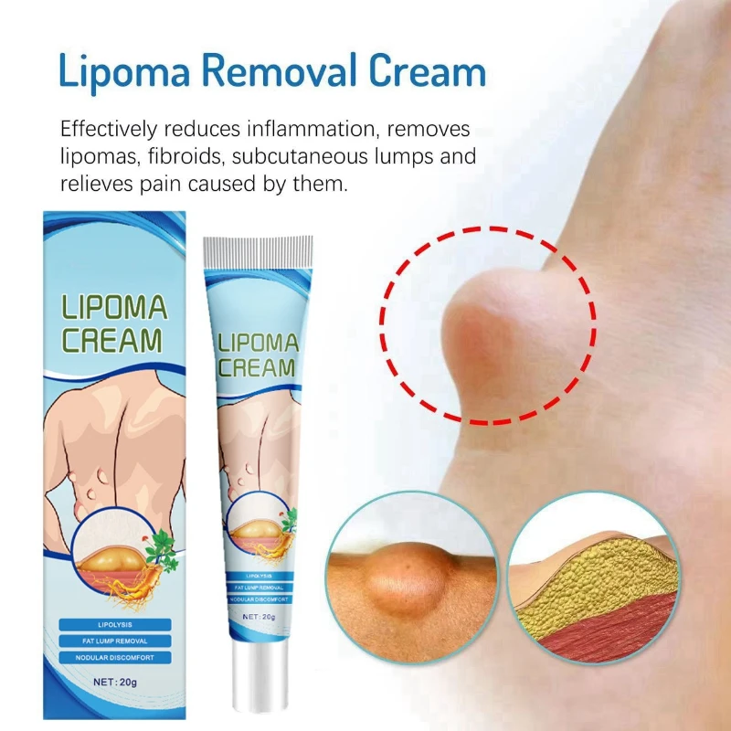 

Lipoma Ointment Effectively Removal Lipoma Fibroids Cream Body Cream Dissolving Fat Easy To Use Herbal Lipoma Removal Cream