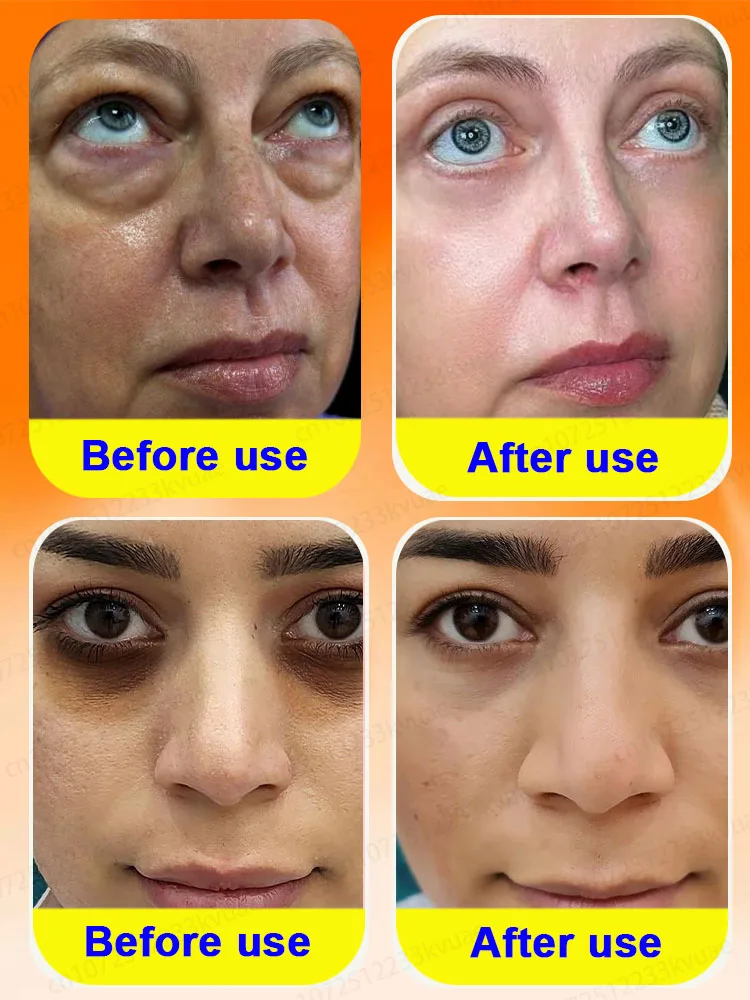 Natural anti-puffing eye cream that eliminates puffiness and dark circles contains centella asiatica and aloe vera extracts