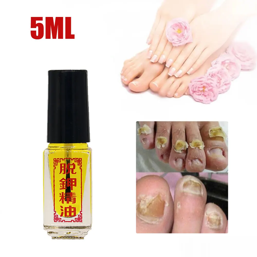 Nail Fungus Remover 3 Days Effect Nail Treatment Removal of onychomycosis Paronychia Anti oil Fungal Nail Infection Toe Fungus oil