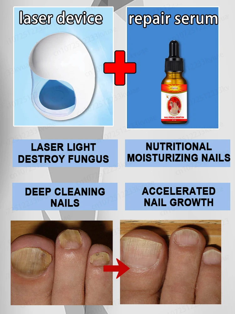 Laser Product To Solves Nail troubles