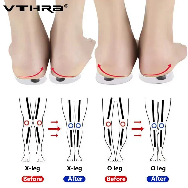 Orthotic Insoles Shoe Insoles Orthopedic Insoles Heel Pads Magnets Silicon Orthopedic Insoles Foot Care Tool For Men Women Health Care O/X Type Legs Knee Varus Correction 1 Pair