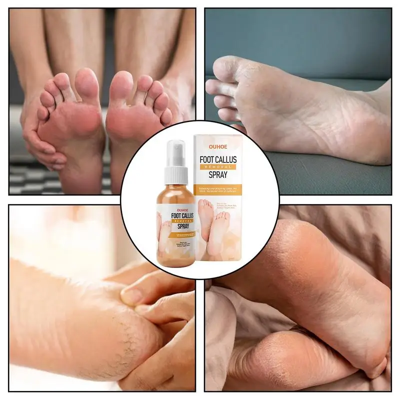 Foot Corn Removal Liquid Painless Callus Remover For Feet Repair Spray Foot  Peeling Spray Orange Oil Feet Instant For Dry Skin - AliExpress