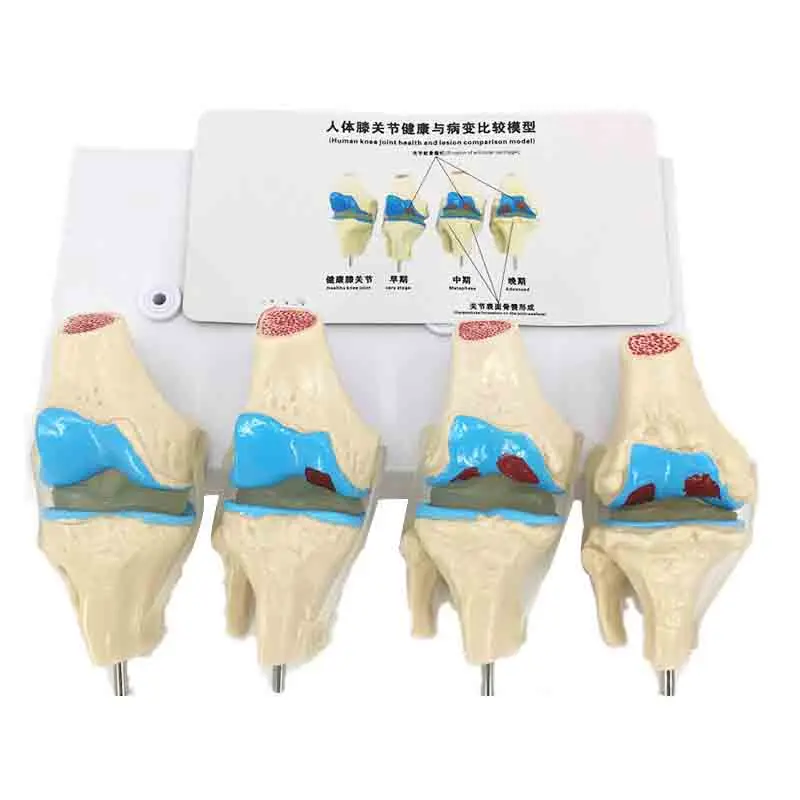 

Comparison of Knee Joint Diseases Medical Teaching Model