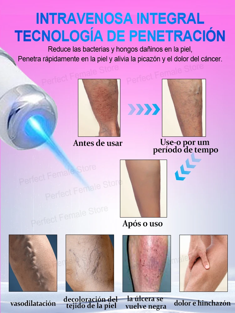 Eliminar Varices Depilacion Laser Diodo Y Varices Depilacion Con