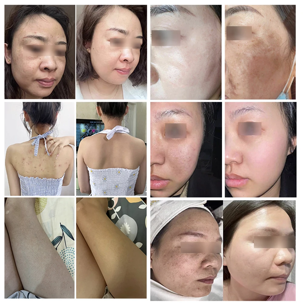 70% 10ml AHA acid 30ml Fruit acid neutralizer glycol sets for Chemical Peeling