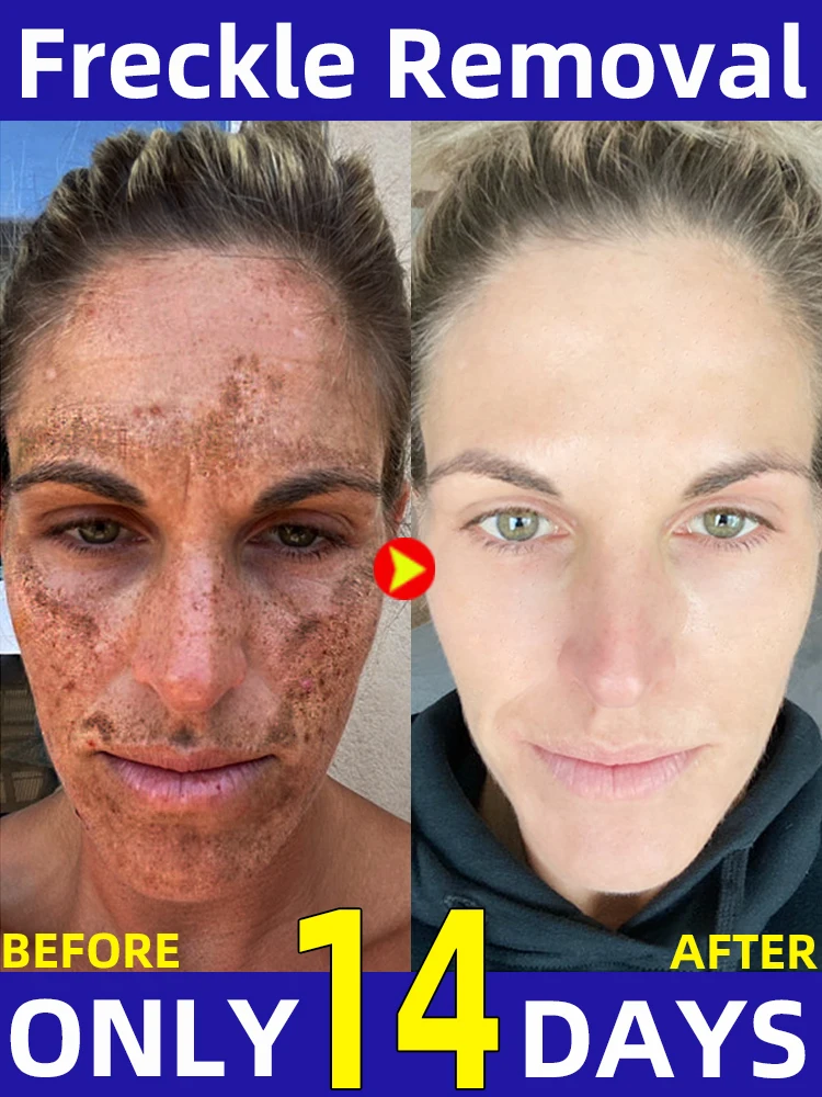 Dark Spot Remover Cream Freckles Melasma 1
