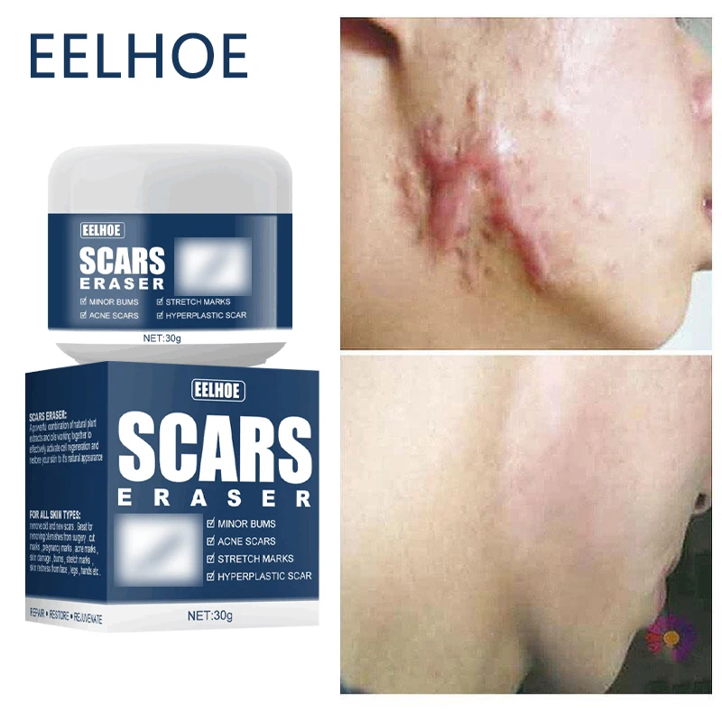 Eraser Burn Scars