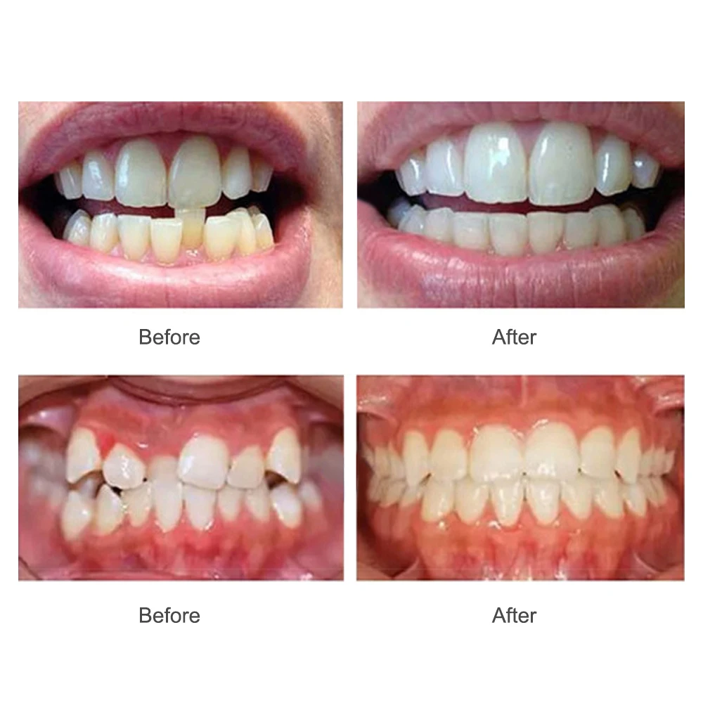 Teeth alignment trainer oral care sets three-stage teeth physical corrector dental appliance tooth orthodontic braces