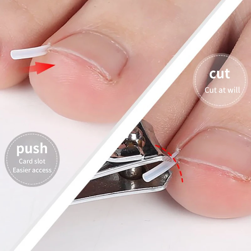 50pcs Ingrown Toenail Correction Tool Invisible Ingrown Toe Nail Treatment Pad Groove Straightening Clip Brace Foot Care Tool 5