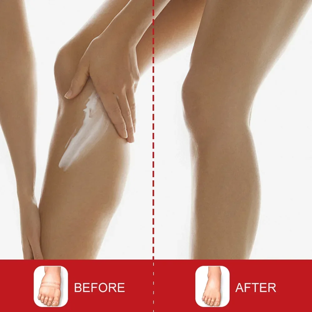 20g Leg Relief Cream For Circulation Relieve Foot Edema Massage Cream For Swollen Legs And Ankles Body Health Care personal health care,pain analgesic cream