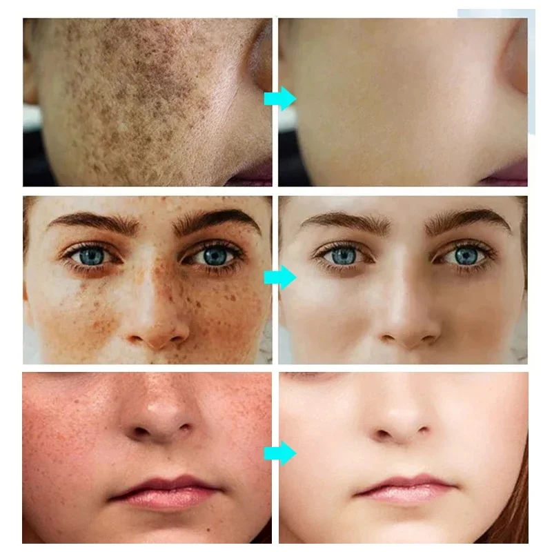 Face Brightening Cream Niacinamide Reduce Melasma Melanin Lighten Dark Skin Chloasma Serum Weaken Fine Lines Care niacinamide serum whitening body cream