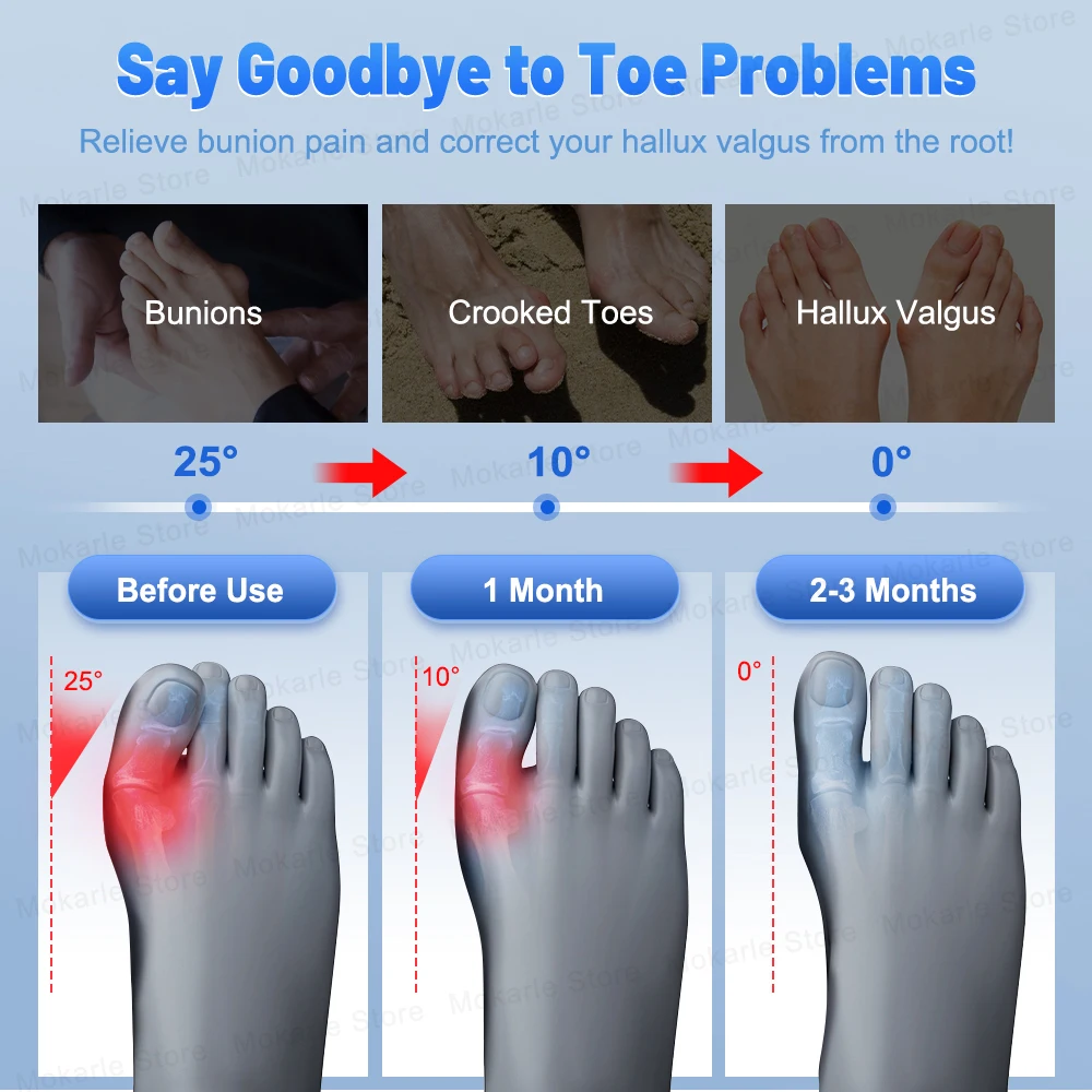 Unisex Bunion Corrector Foot Hallux Valgus Braces Toe Corrector Toe Separator Straightener