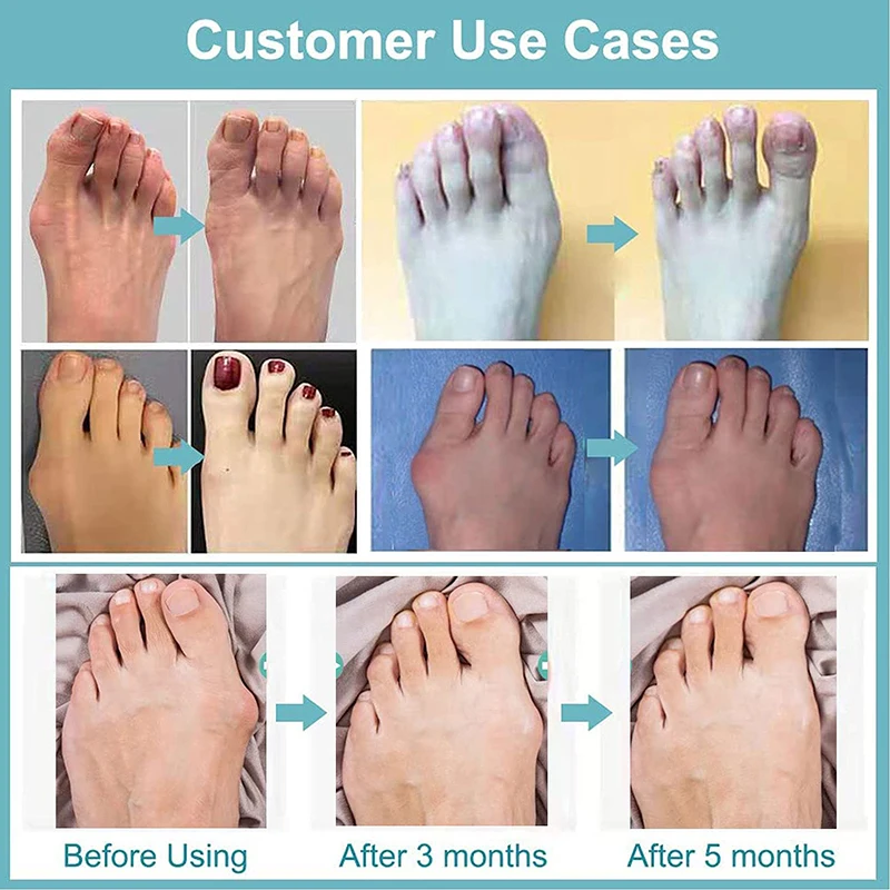 Toe Separator 2Pcs Gel Bunion Bone Ectropion Adjuster