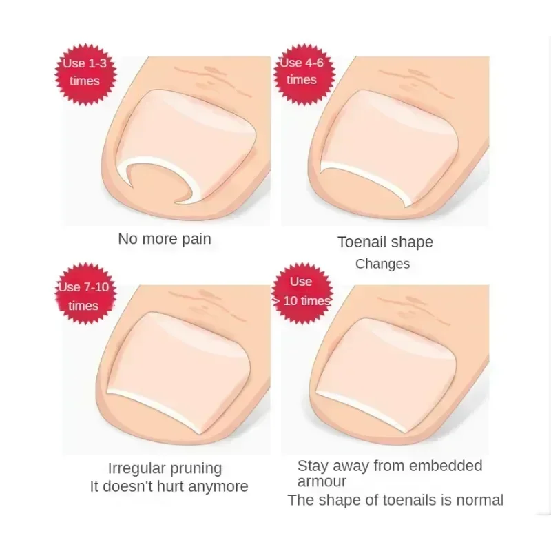 Ingrown Toenail Corrector Straightening Clip Pedicure Foot Nail Care Tools Stainless Steel Pedicure Treatment Onyxis Correction 4