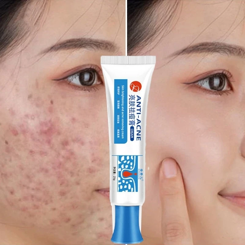 

Acne Removing Cream Acne Treatments Blackhead Removal Cream Skincare Shrink Pores Anti-acne Creams Facial Acne Removing Cream