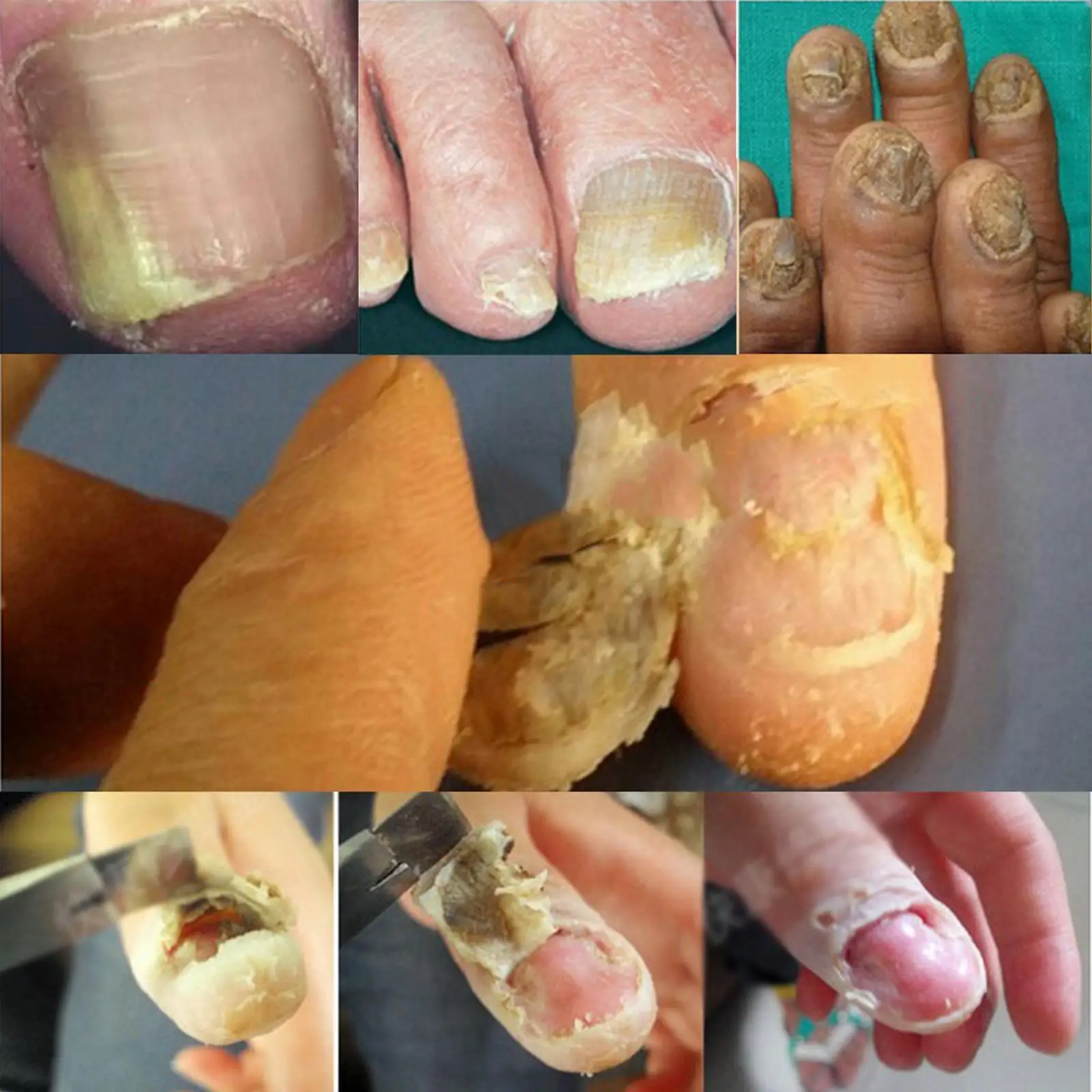 

Herbs Toe Nail Treatment Treatment Removal Nail Care Lotion 20g
