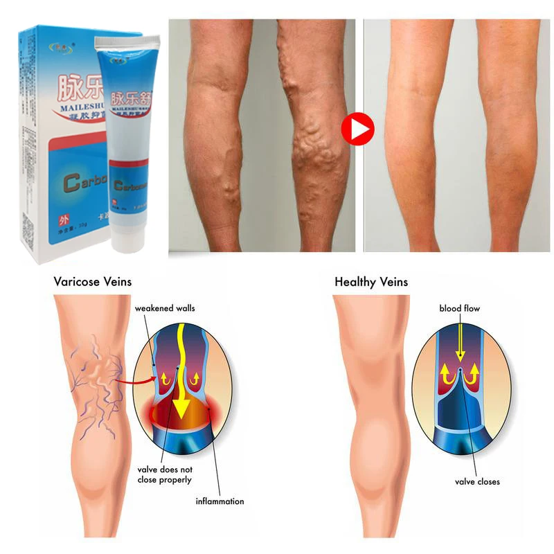 

10/22pcs 30g Varicose Veins Ointment Legs Smoothing Redness Repair Dressing Phlebitis Analgesics Spider Vein Pain Care Cream