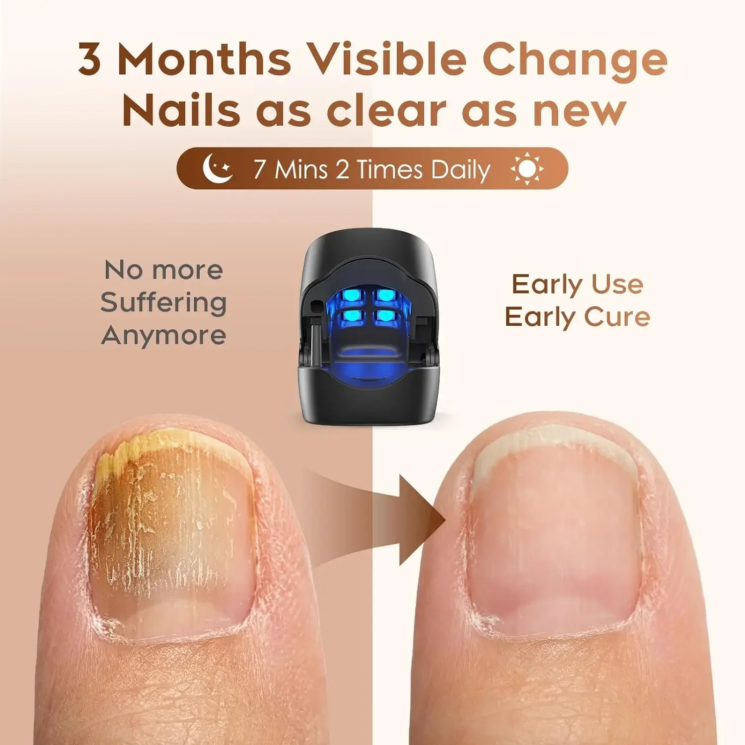 Nail Fungus Treatment Blue Light Nail Salon LED Laser Device for Cleaning Onychomycosis USB Charge 905nm Infrared Light 470nm