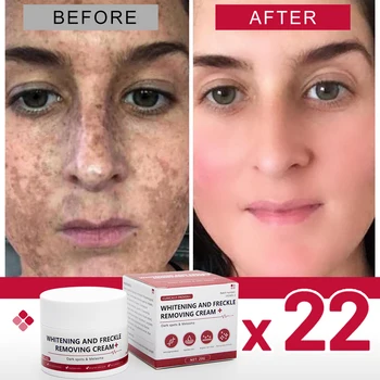 Whiten Freckle Cream Brighte  Remove freckle Dark  Spot Melasma removes facial spots spots Improve dullness